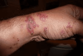 What is the black death (human plague)? 5 What is the black death (human plague)? image 13 What is the black death (human plague)?