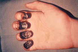 What is the black death (human plague)? 4 What is the black death (human plague)? image 14 What is the black death (human plague)?