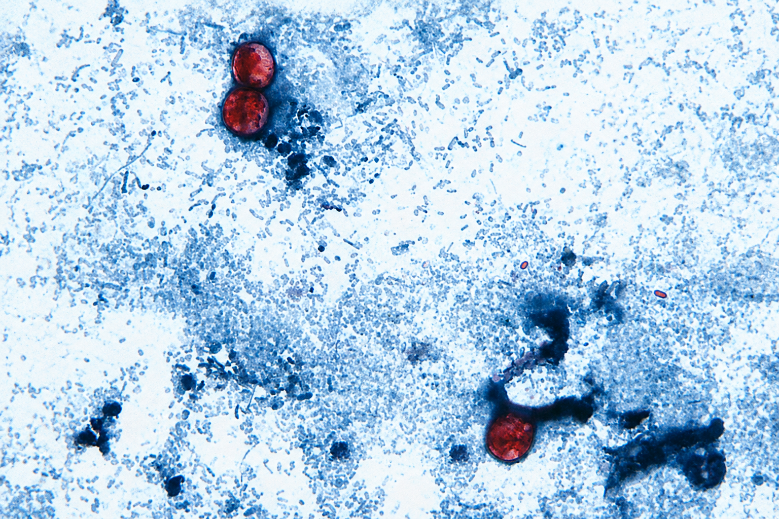 Cyclospora Outbreak Spreads to Nine States: What to Know